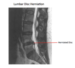 Lumbar Herniated Disc - Physical Therapy 101